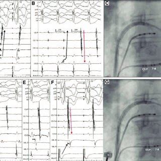 retrograde left ventricular pacing